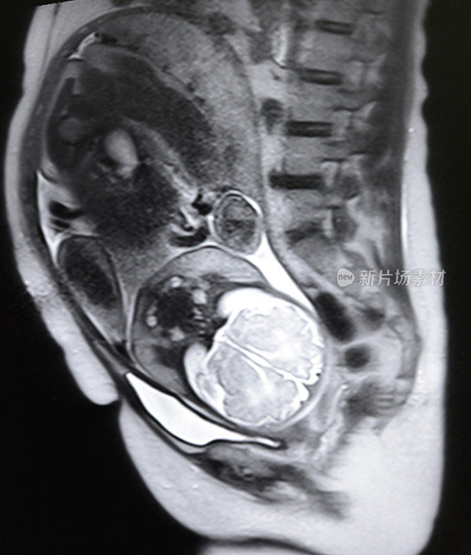胎儿和孕妇MRI T2体重图像